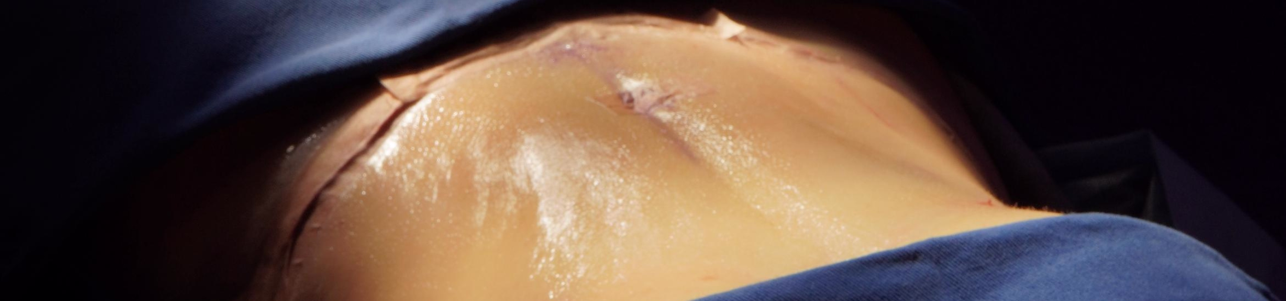 Comparación de tipos de abdominoplastia según caso