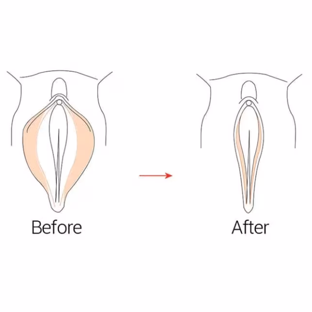 Diagrama antes y después de la intervención en el canal vaginal - vaginoplastia